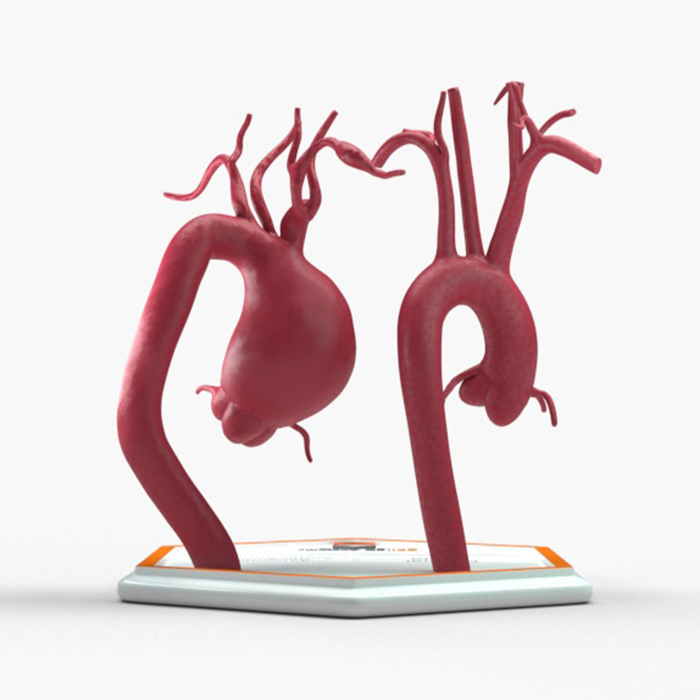 Supracoronary Ascending Aortic Aneurysm and Normal
