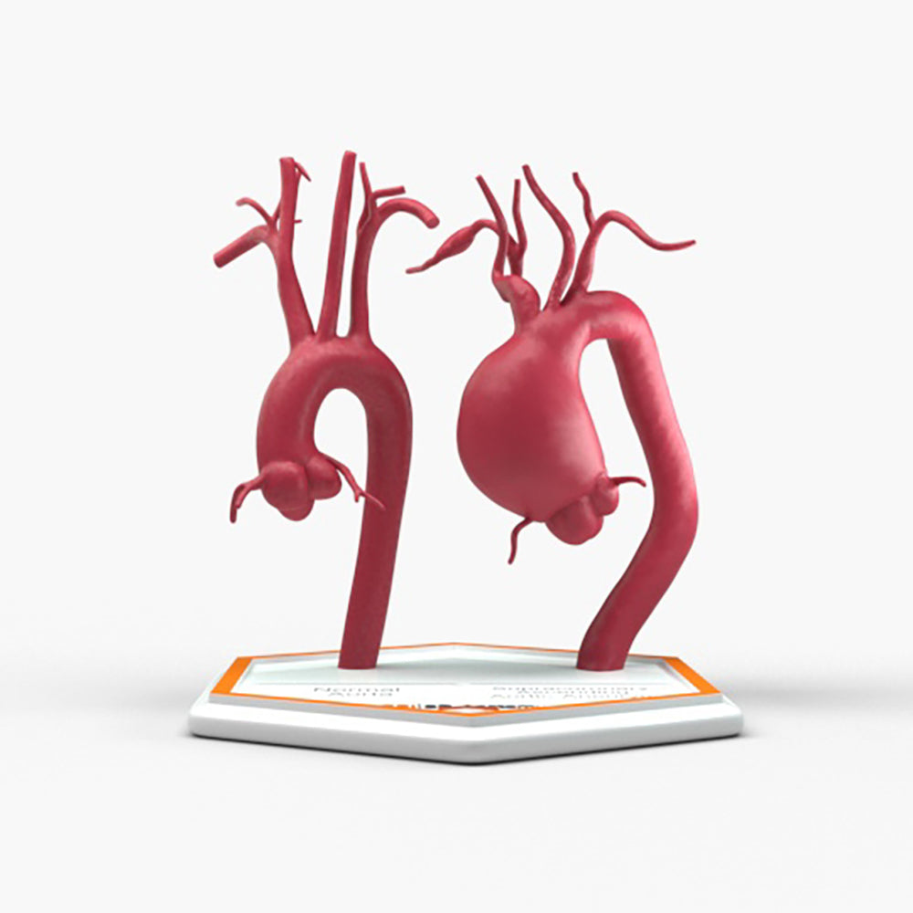 Supracoronary Ascending Aortic Aneurysm and Normal