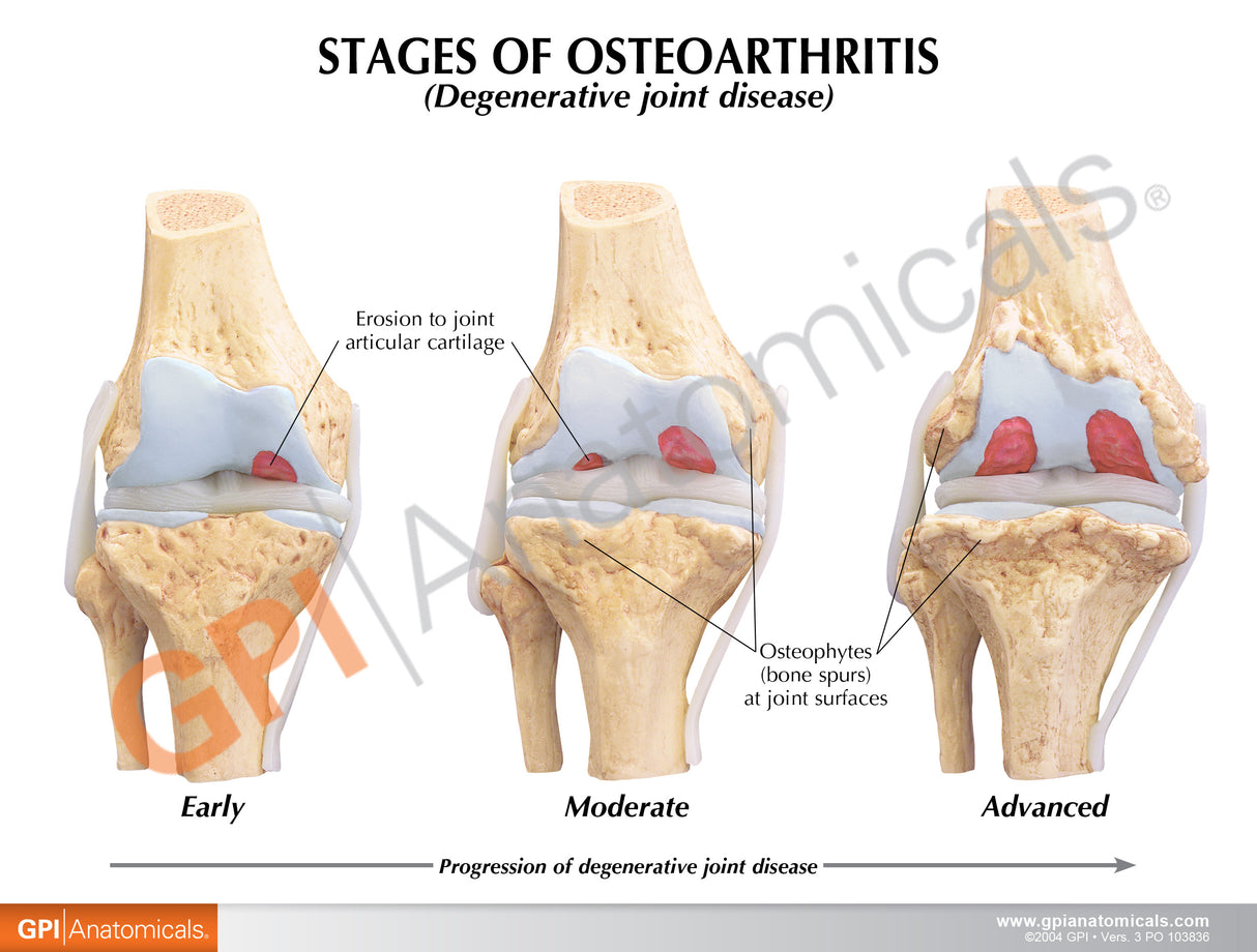 4-Stage Osteoarthritic Knee