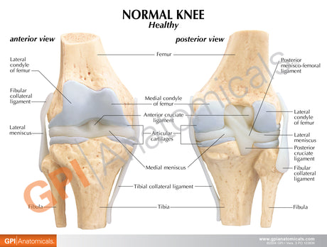 4-Stage Osteoarthritic Knee Education Card