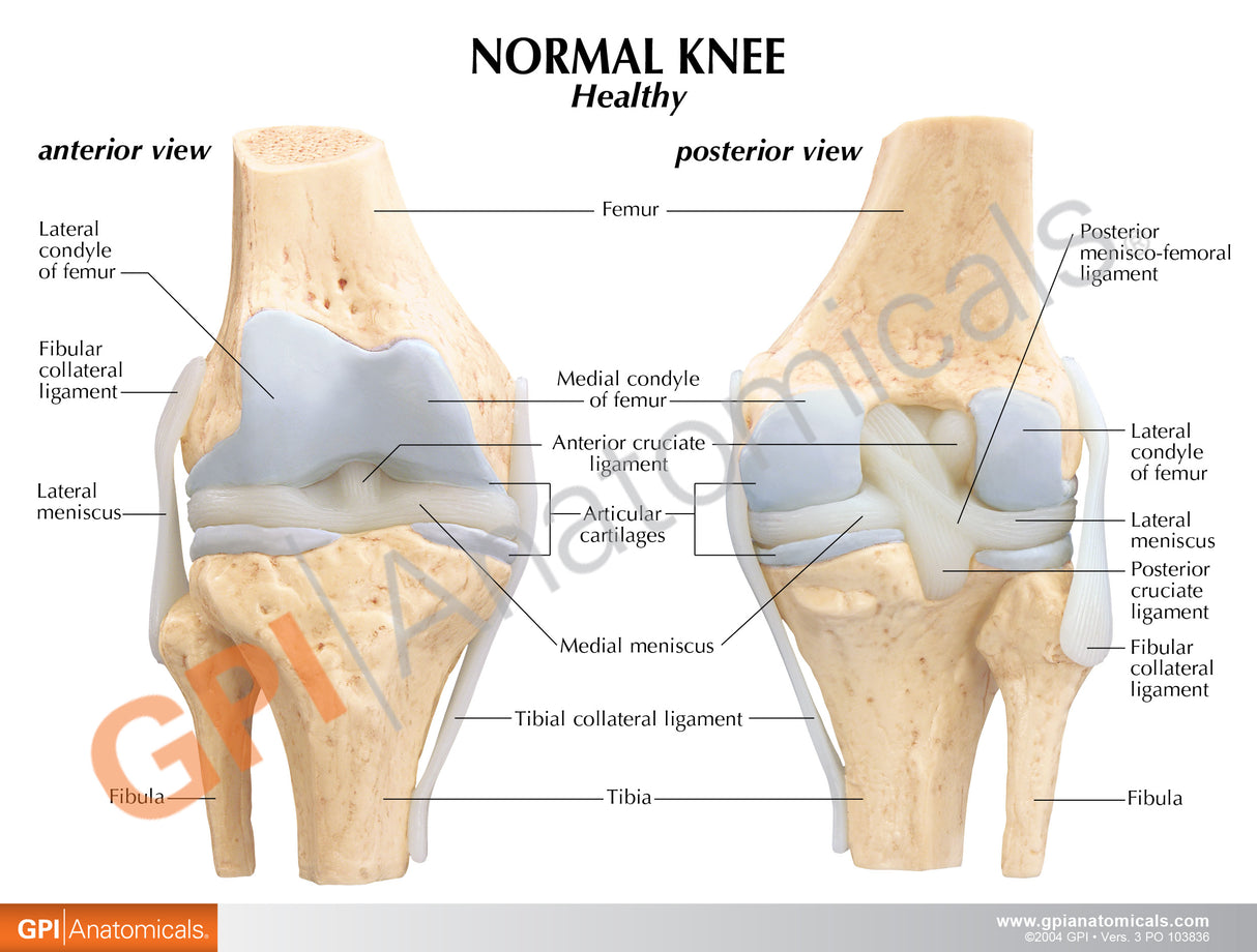 4-Stage Osteoarthritic Knee