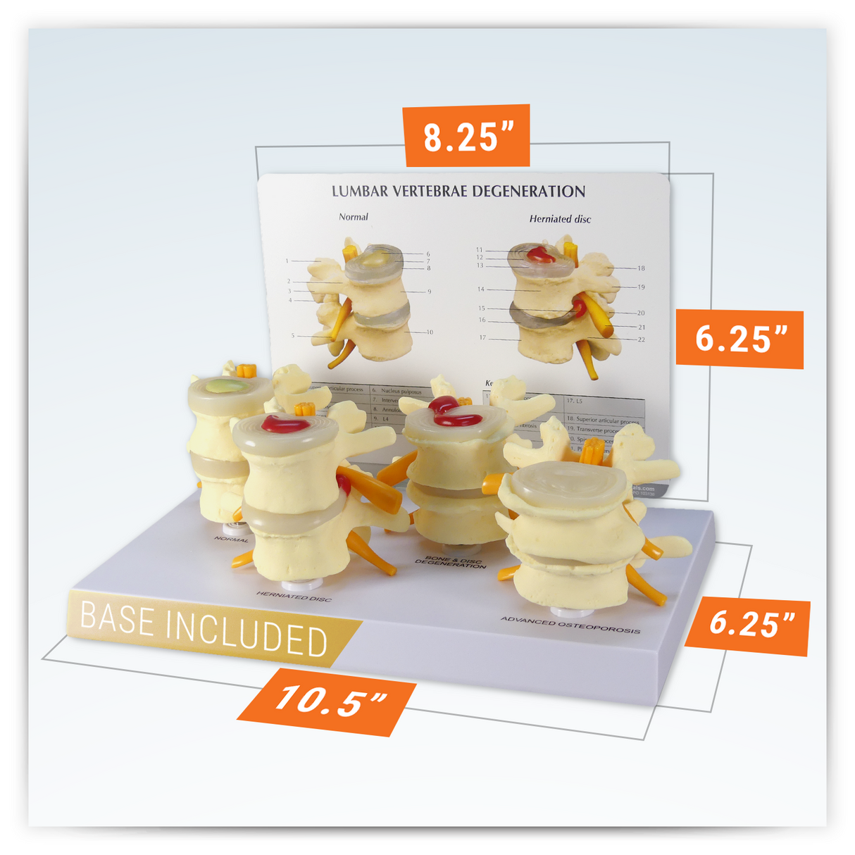 4-Stage Vertebrae Model