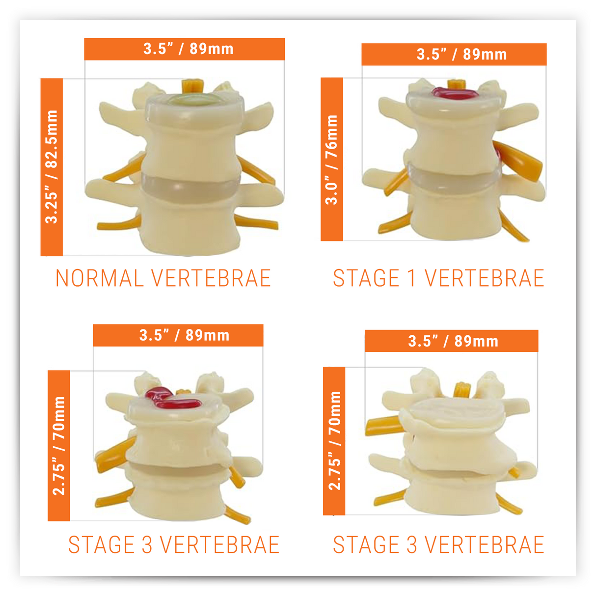 4-Stage Vertebrae Model