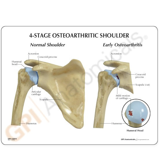 4-Stage Osteoarthritis (OA) Shoulder Model