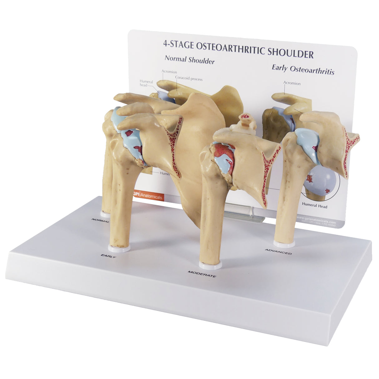 4-Stage Osteoarthritis (OA) Shoulder Model