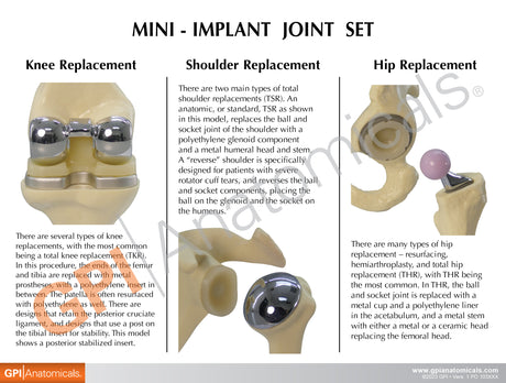 Mini Implant Joint Set