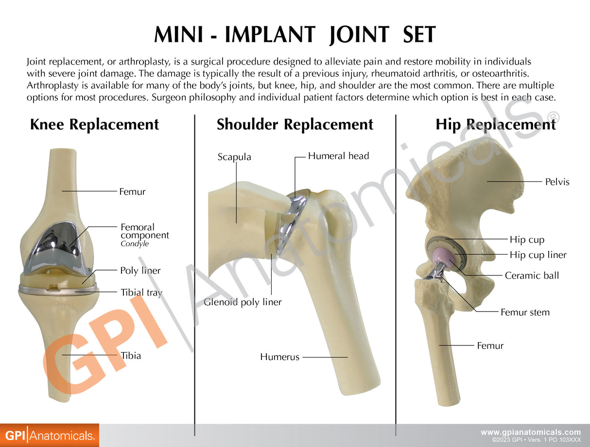 Mini Implant Joint Set