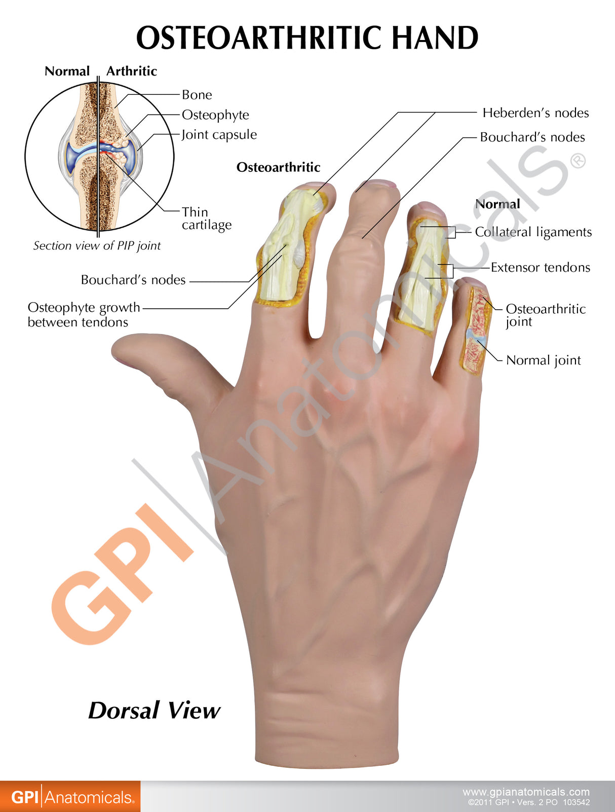 Right Hand with Osteoarthritis Education Card