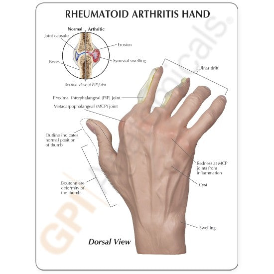 Right Hand Model with Rheumatoid Arthritis