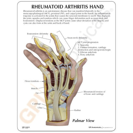Right and with Rheumatoid Arthritis Education Card