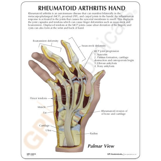 Right Hand Model with Rheumatoid Arthritis