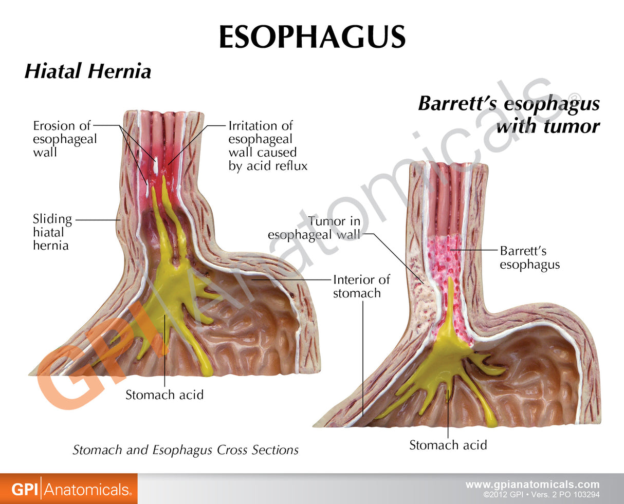 4-Piece Stomach Model Set with Gastroesophageal Reflux Disease (GERD)