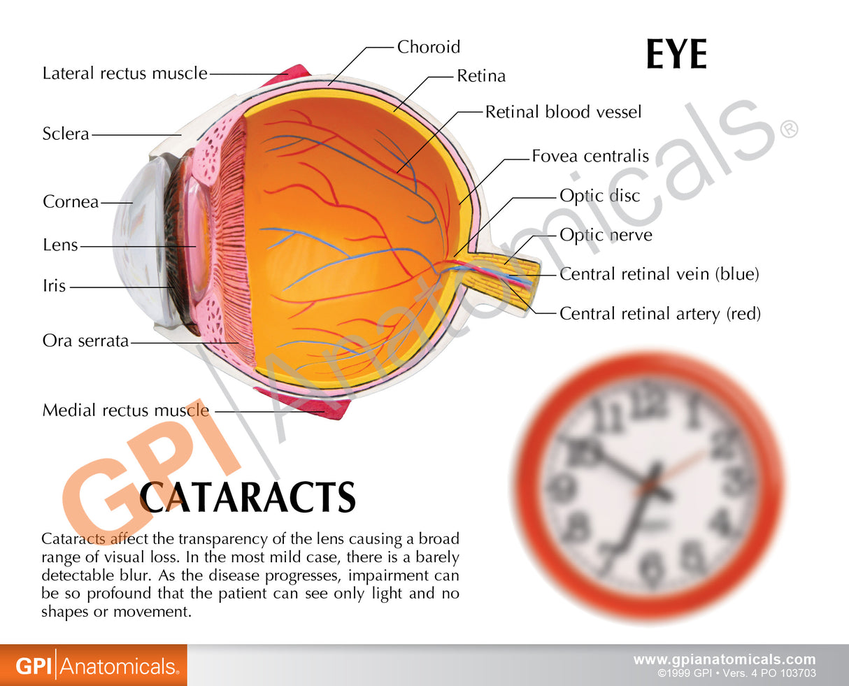 Cataract Eye Model