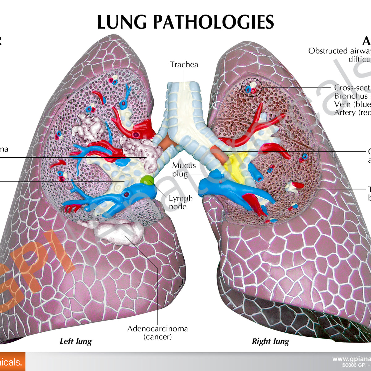 Lung Cancer Education Card – GPI 3D Anatomy