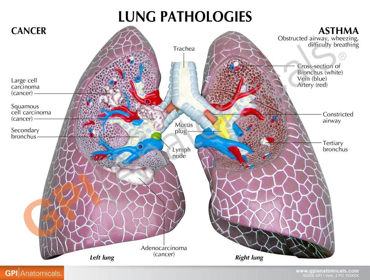 Lung Model Set with Pathologies