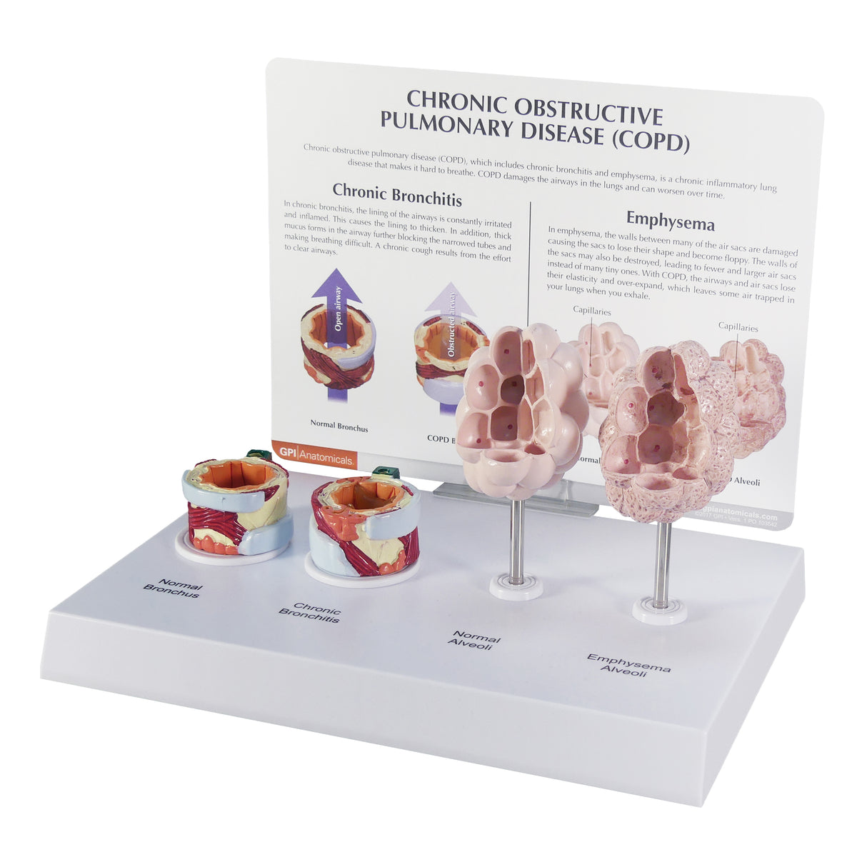 Respiratory System Model with Chronic Obstructive Pulmonary Disease (COPD)