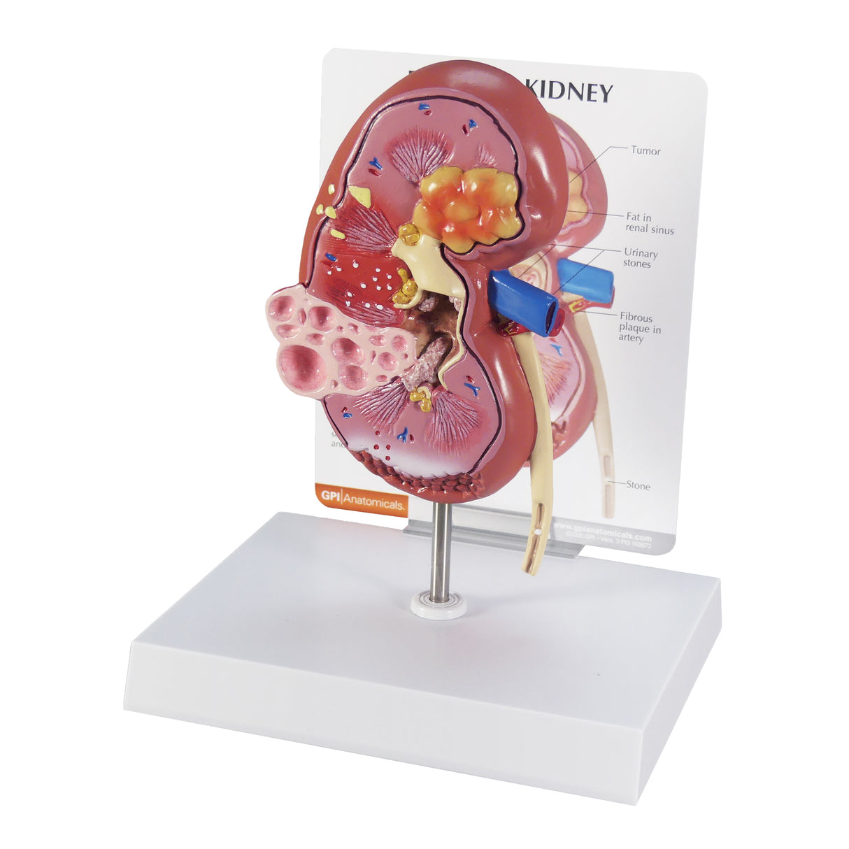 Normal and Diseased Kidney Model
