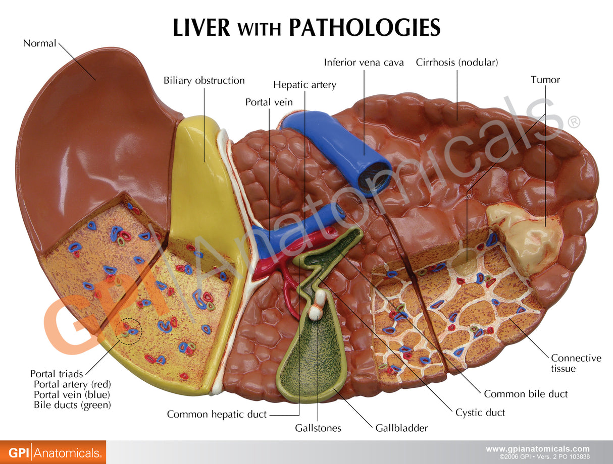 Liver Model with Common Pathologies
