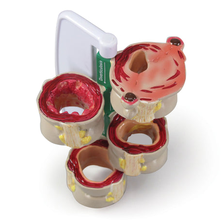 4-Piece Colon Model Set with Pathologies