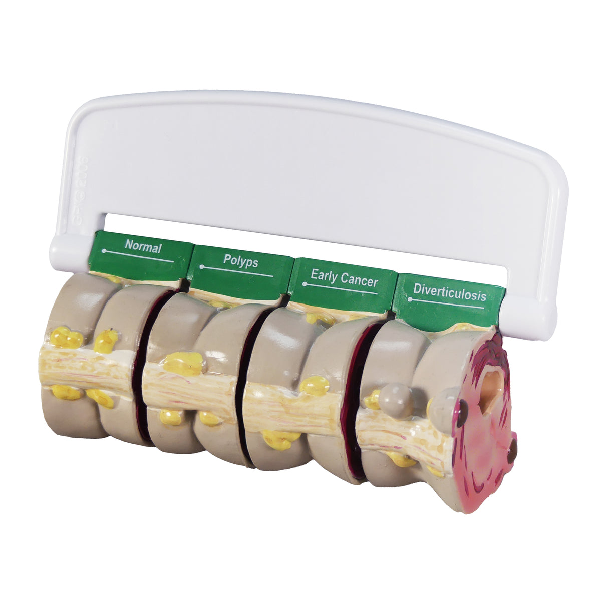 4-Piece Colon Model Set with Pathologies