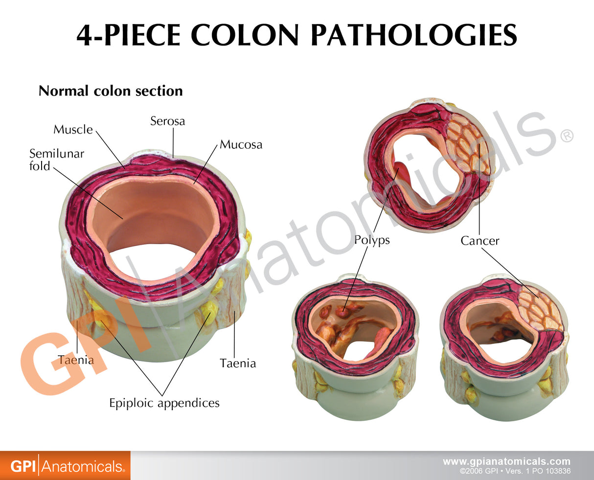 4-Piece Colon Model Set with Pathologies