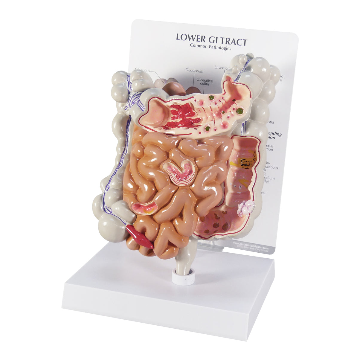GI Tract Model with Common Pathologies
