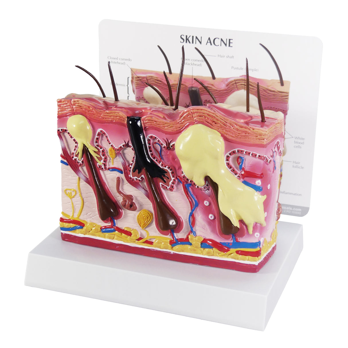 Skin Acne Cross-Section Model