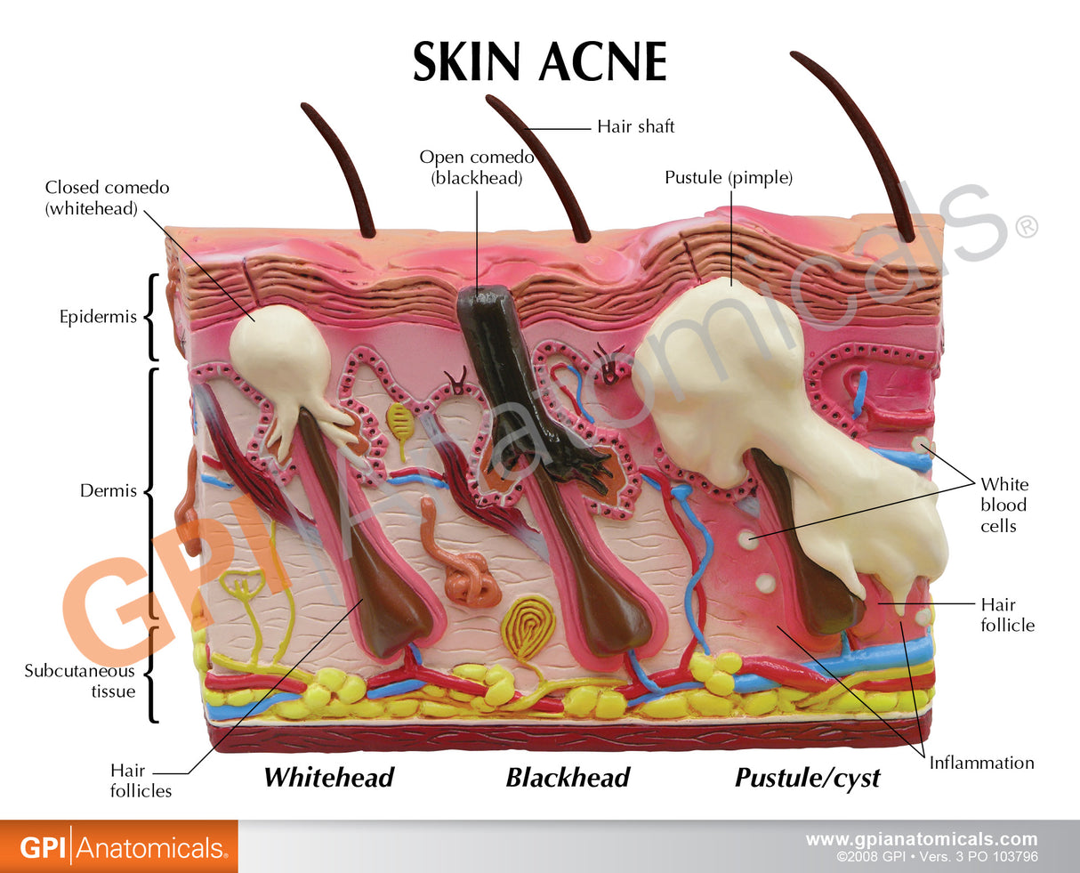 Skin Acne Cross-Section Model