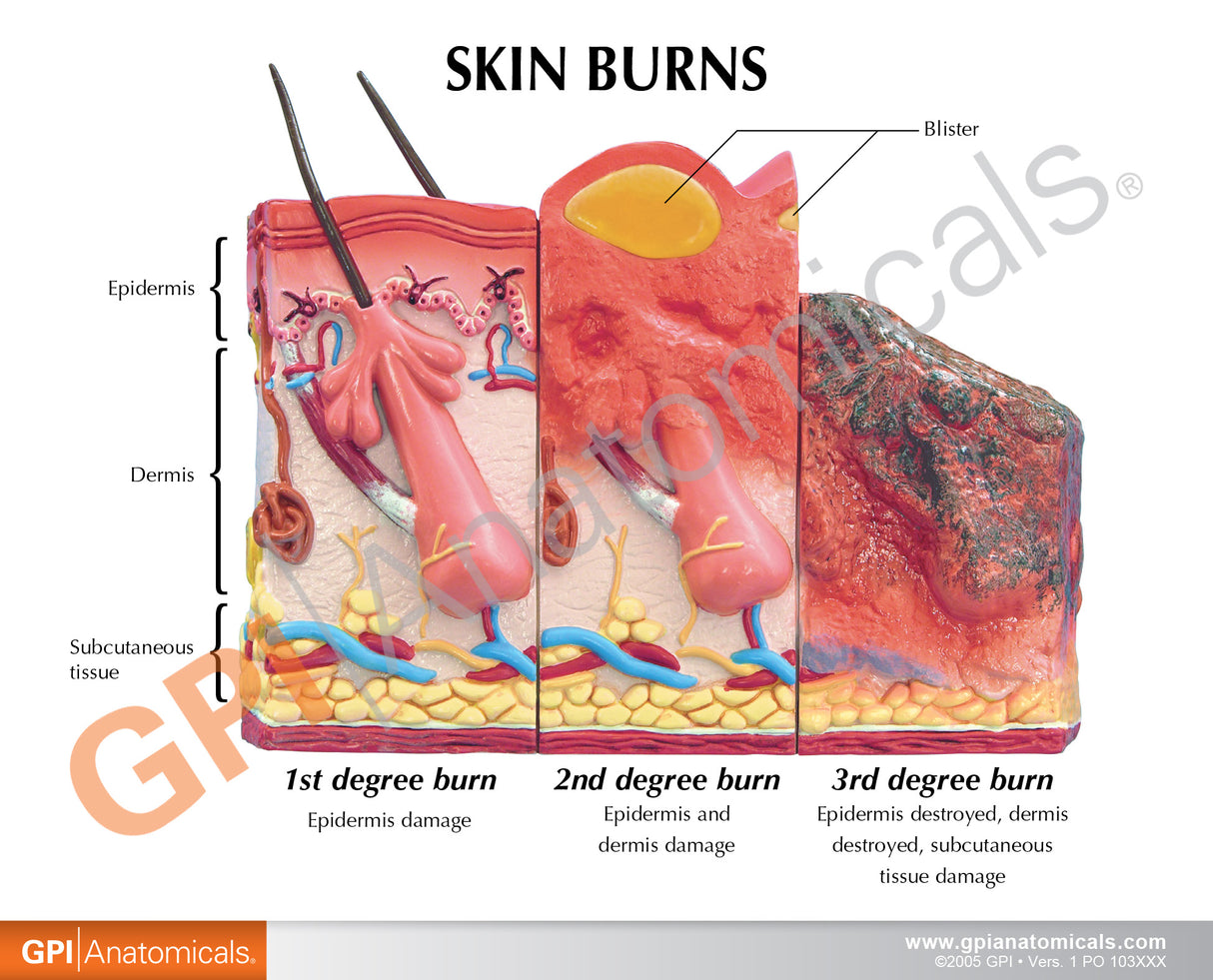 Skin Burn Model
