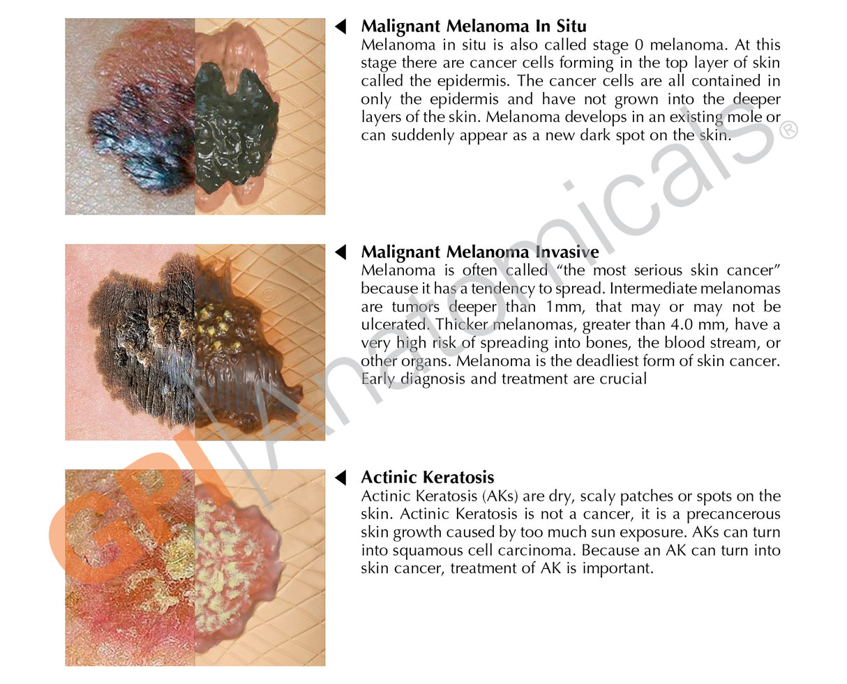 Melanoma Skin Cancer