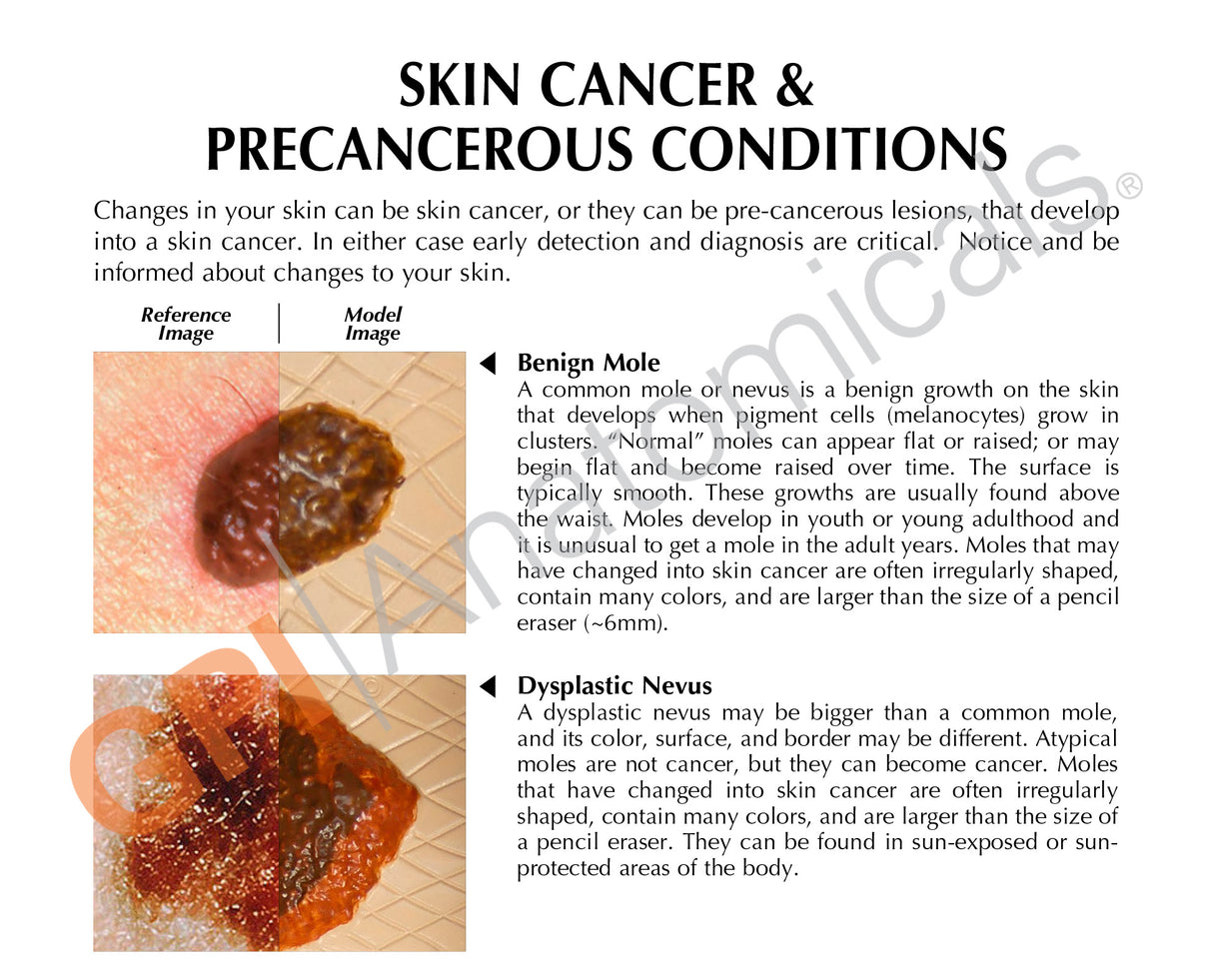 Melanoma Skin Cancer Education Card