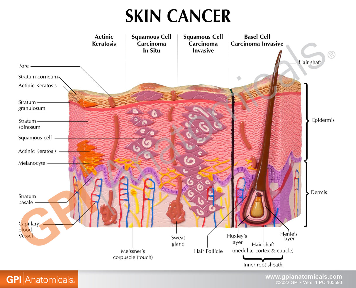 Melanoma Skin Cancer