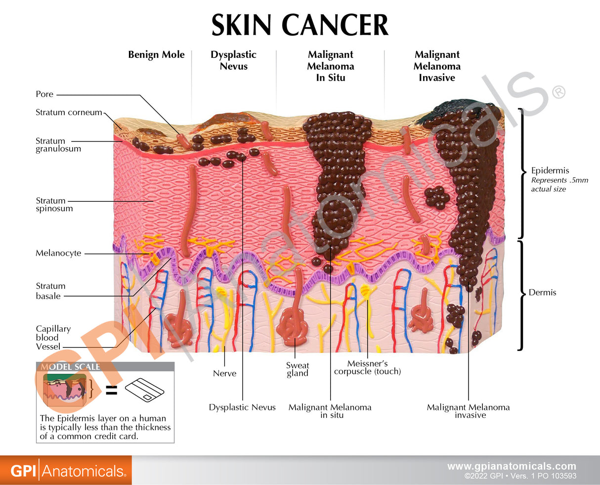 Melanoma Skin Cancer