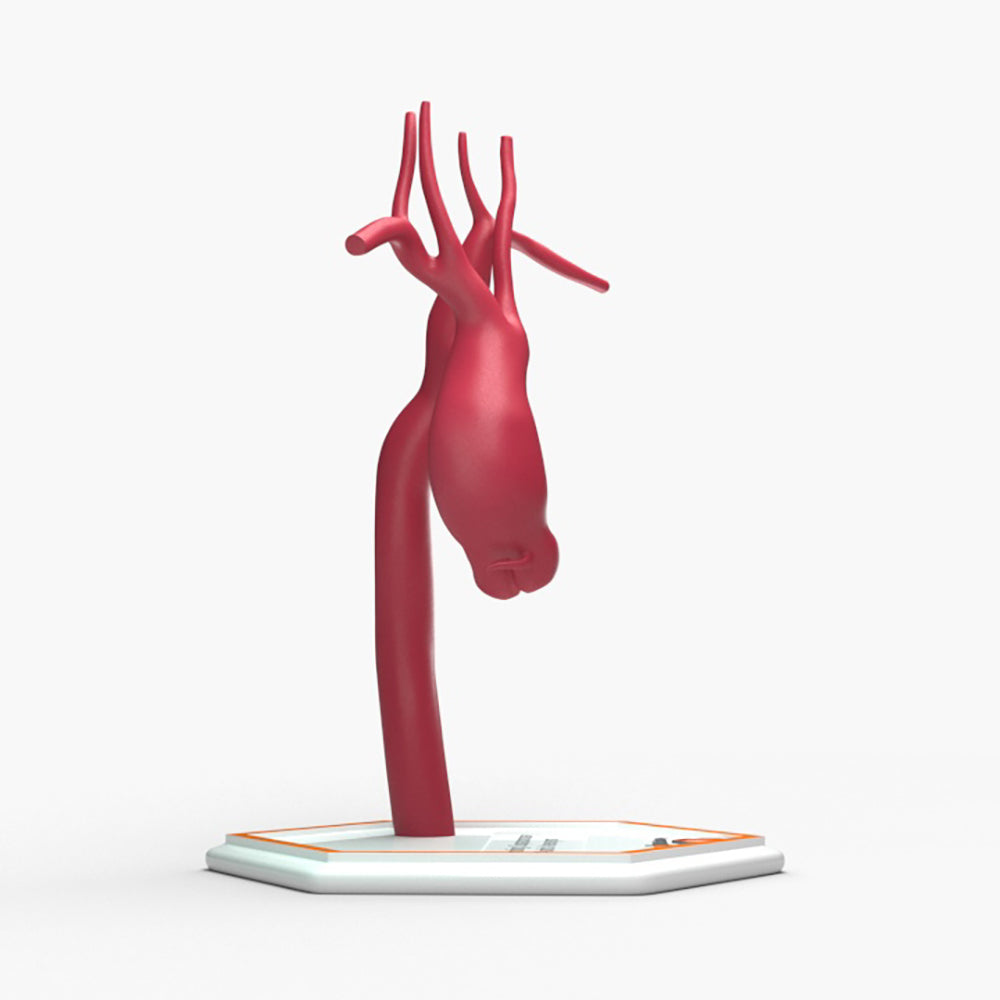 Ascending Supracoronary Aortic Aneurysm