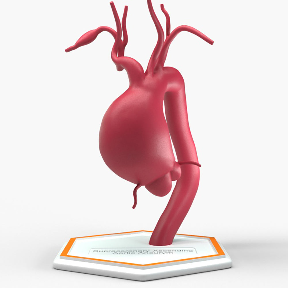 Supracoronary Ascending Aortic Aneurysm