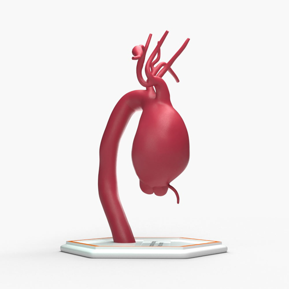 Supracoronary Ascending Aortic Aneurysm