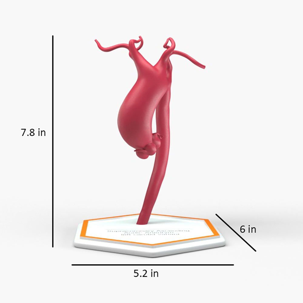 Supracoronary Ascending Aortic Aneurysm Left Carotid Variant