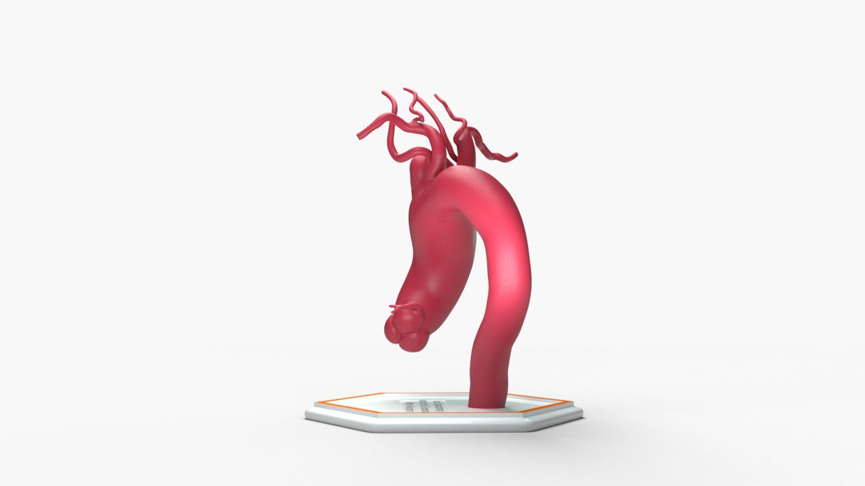 Ascending Supracoronary Aortic Arch and Innominate Artery Aneurysm