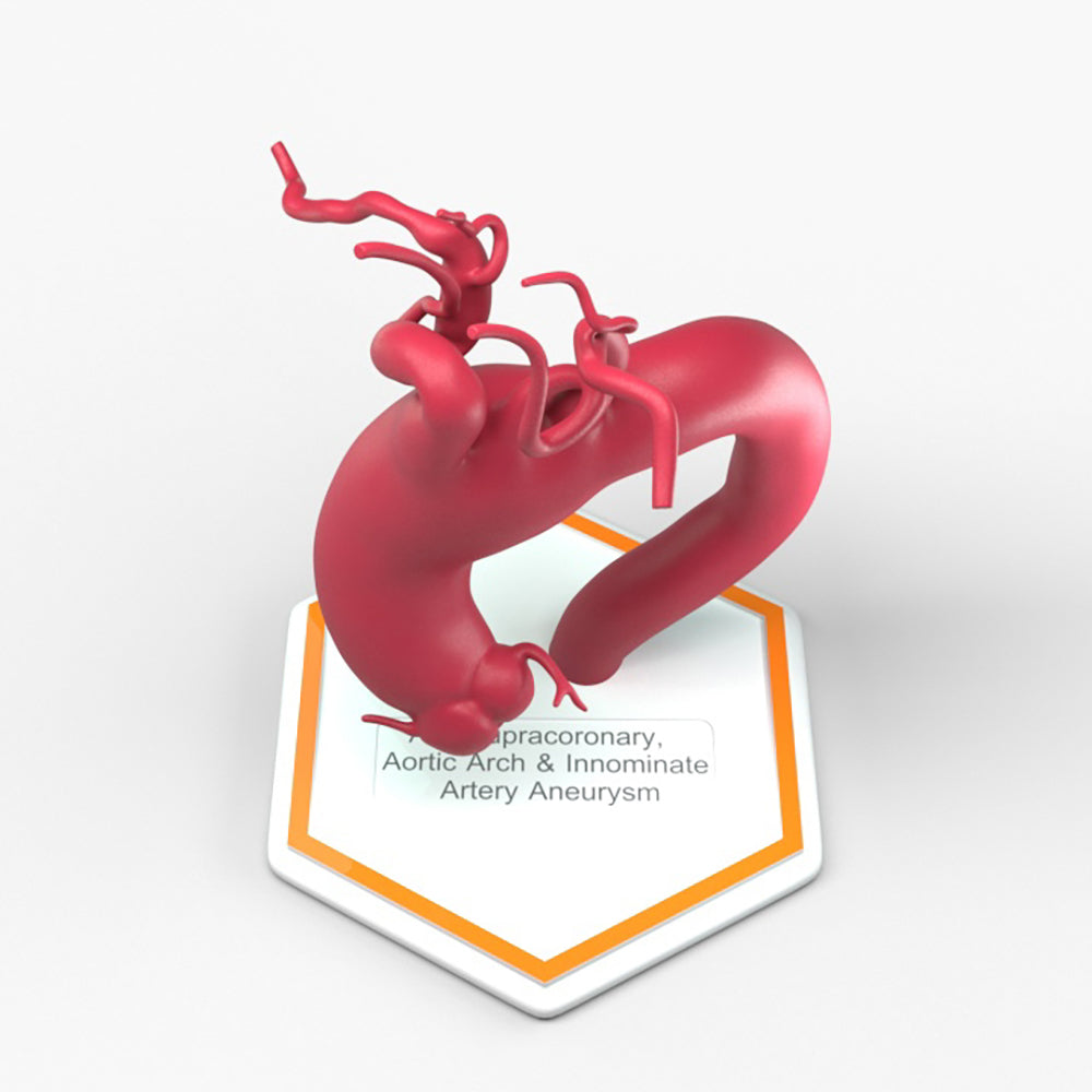 Ascending Supracoronary Aortic Arch and Innominate Artery Aneurysm