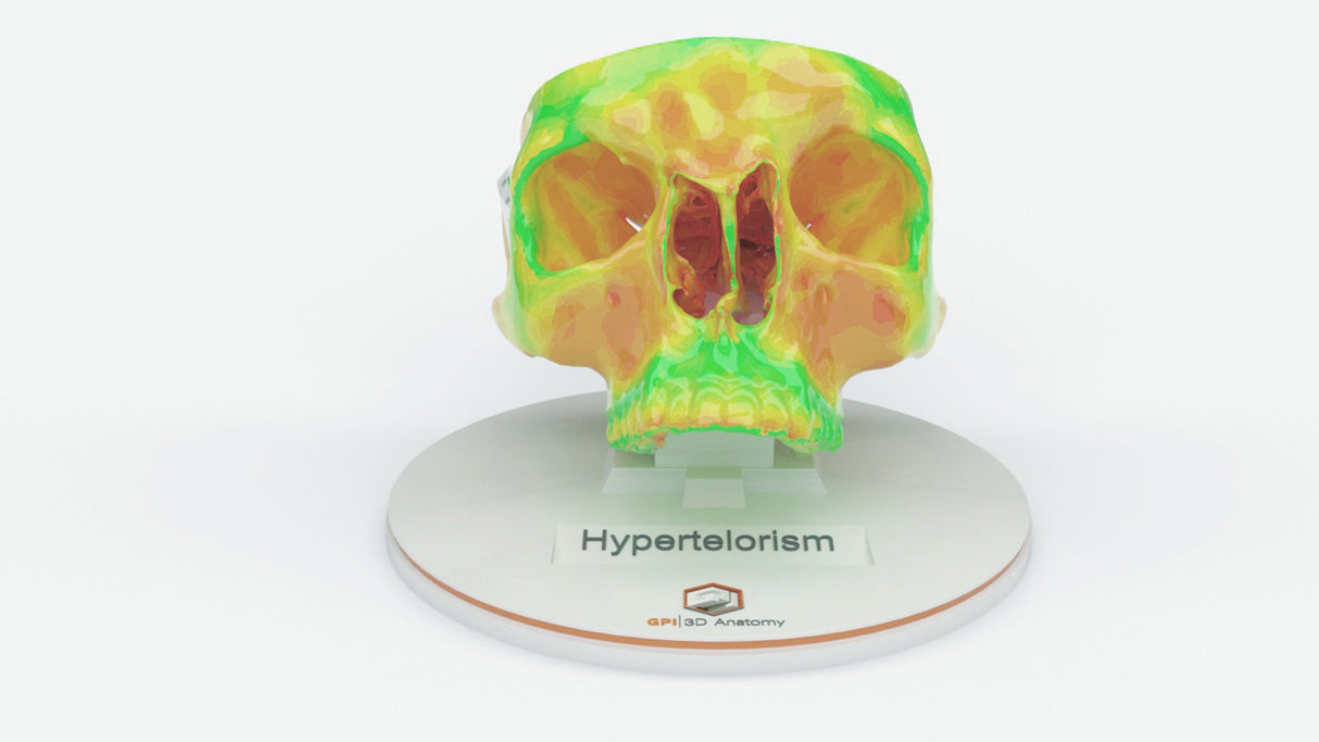 Hypertelorism – Male, 17 Years