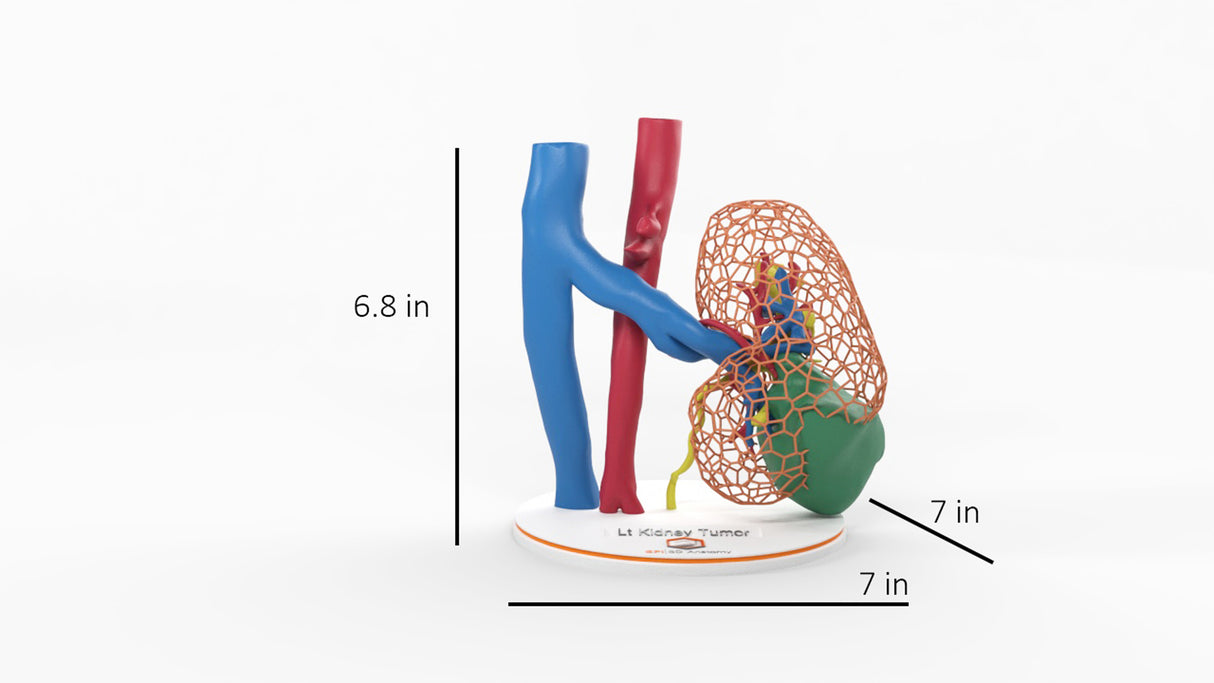 Lattice Left Kidney With Neoplasm - Male, 50 Years