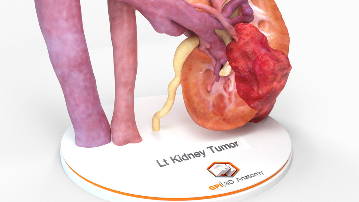 Realistic Left Kidney With Neoplasm - Male, 50 Years
