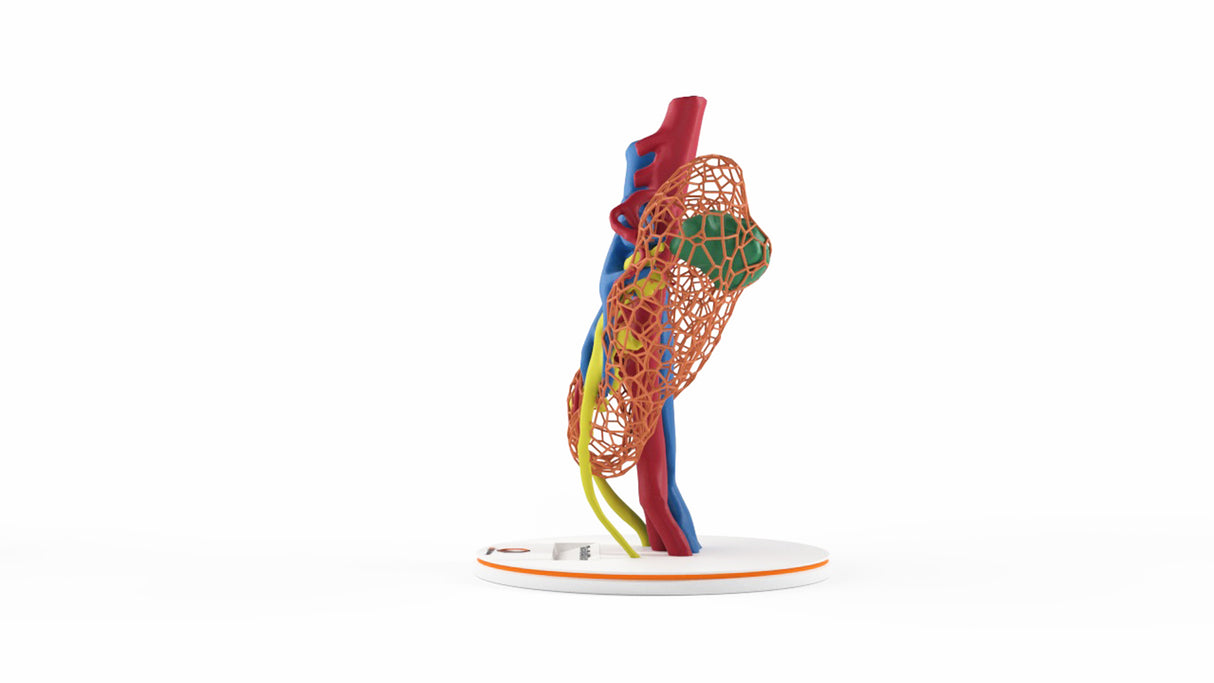 Lattice Horseshoe Kidney With Renal Cell Carcinoma (RCC) – Male, 41 Years
