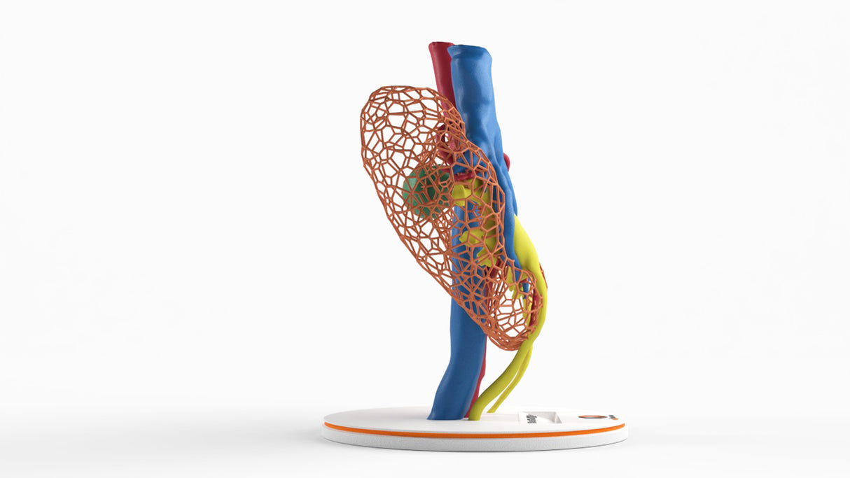 Lattice Horseshoe Kidney With Renal Cell Carcinoma (RCC) – Male, 41 Years