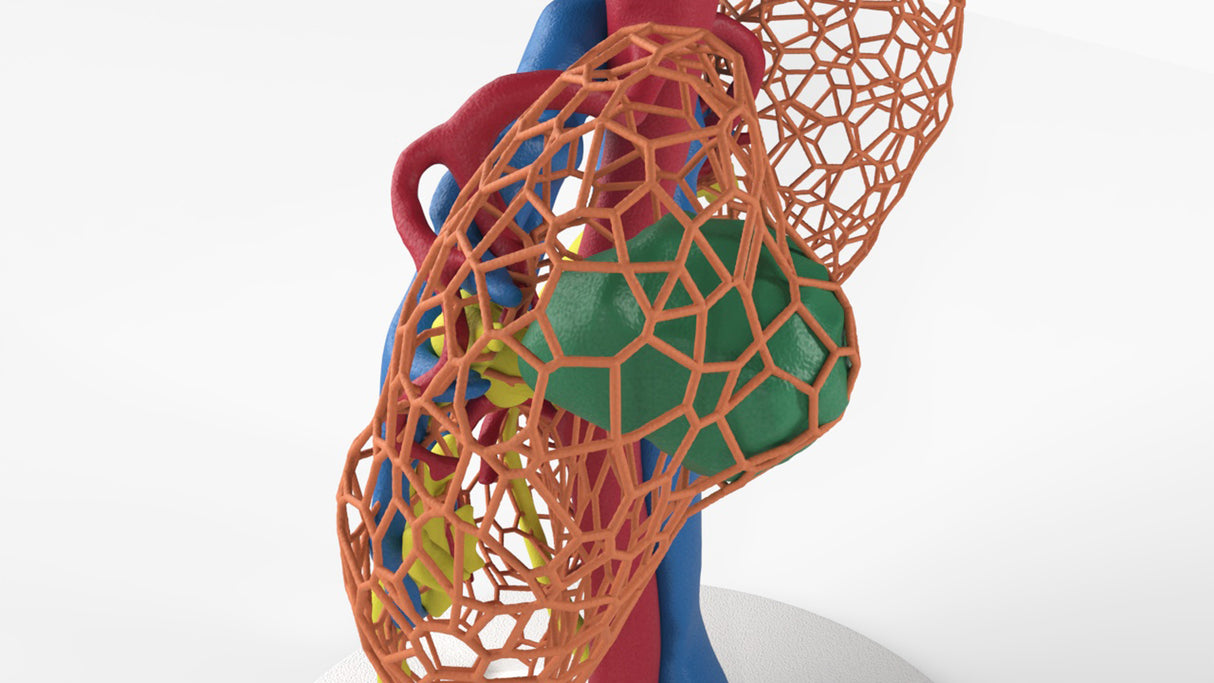 Lattice Horseshoe Kidney With Renal Cell Carcinoma (RCC) – Male, 41 Years