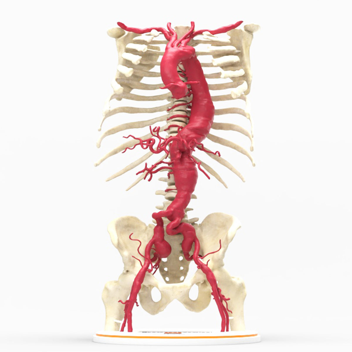 Custom 3D Anatomy Models | Aortic Aneurysm | Thoracoabdominal Bilateral ...