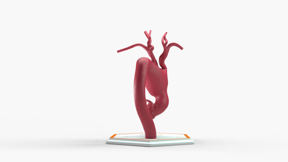 Aortic Arch - Fusiform Ascending Aneurysm