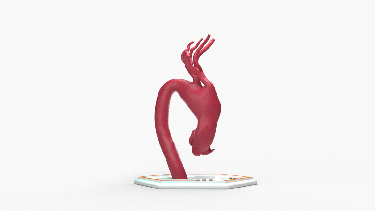 Aortic Arch - Fusiform Ascending Aneurysm