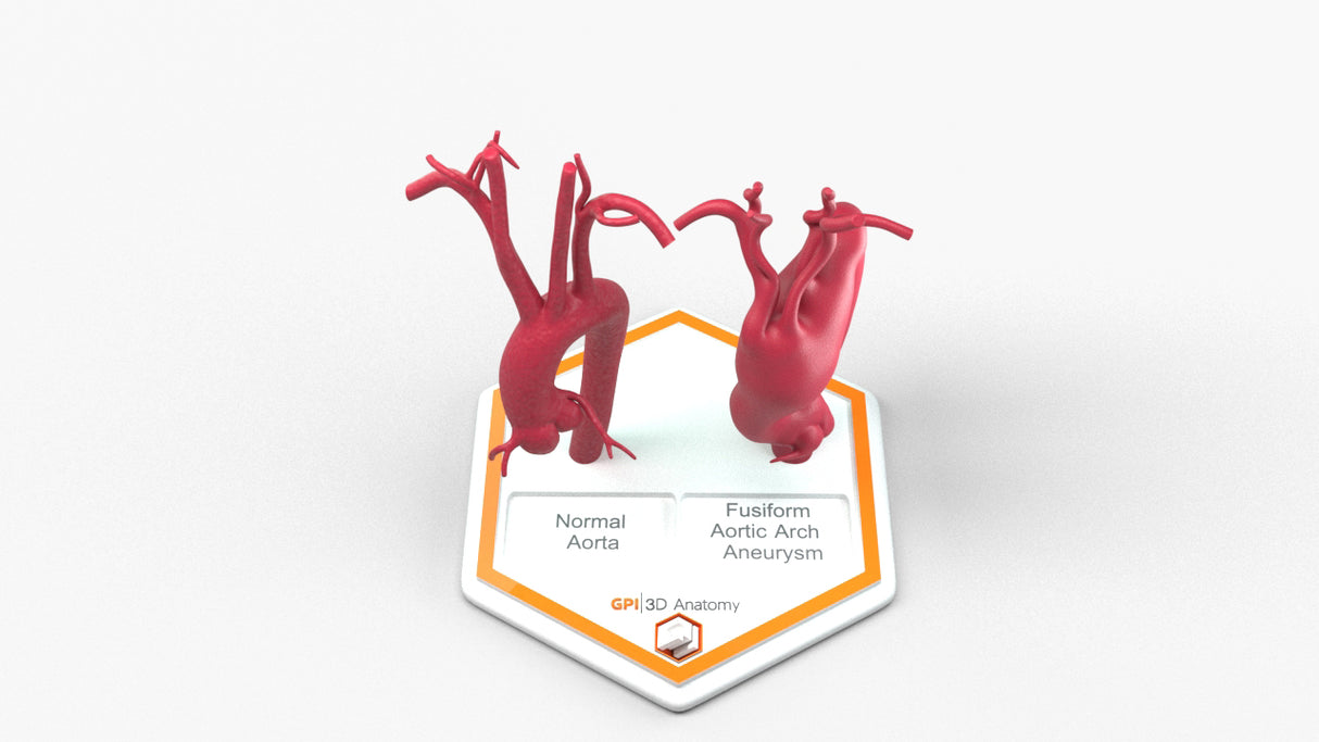 Aortic Arch - Normal & Fusiform Ascending Aneurysm