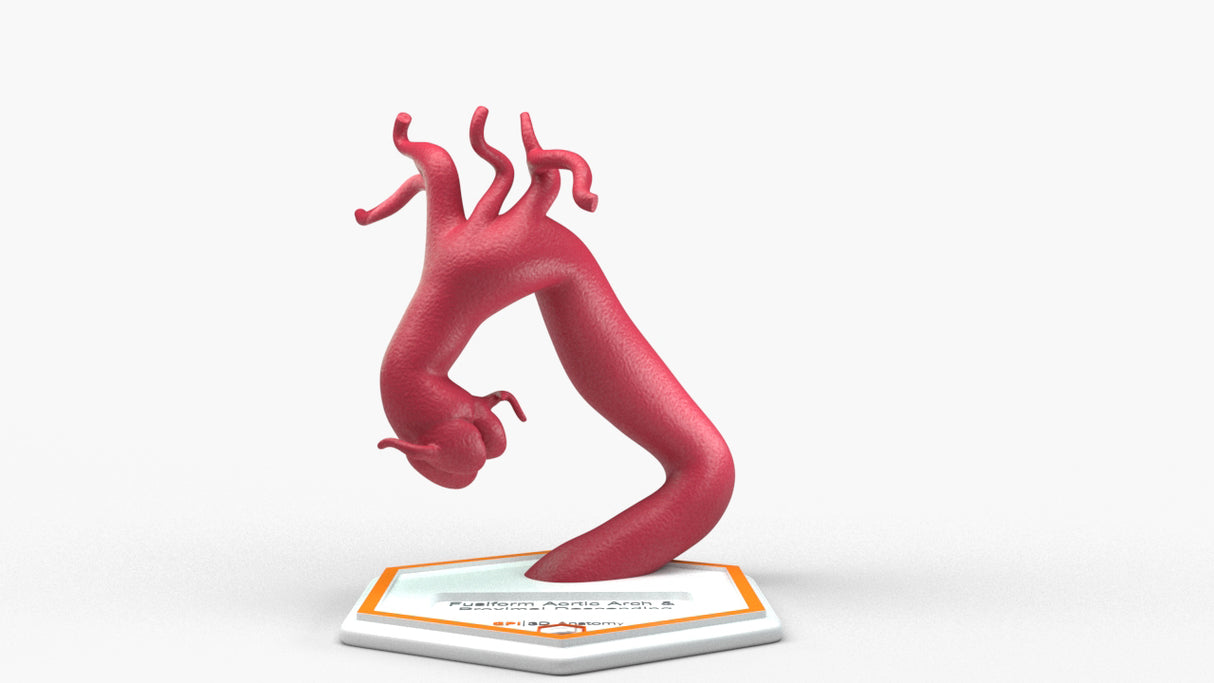 Aortic Arch - Fusiform with Proximal Descending Aneurysm